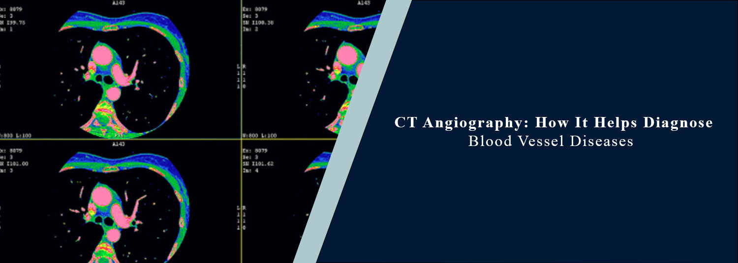 CT Angiography: How It Helps Diagnose Blood Vessel Diseases?