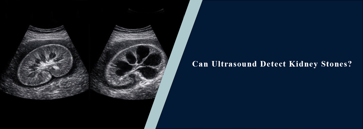 Can Ultrasound Detect Kidney Stones?