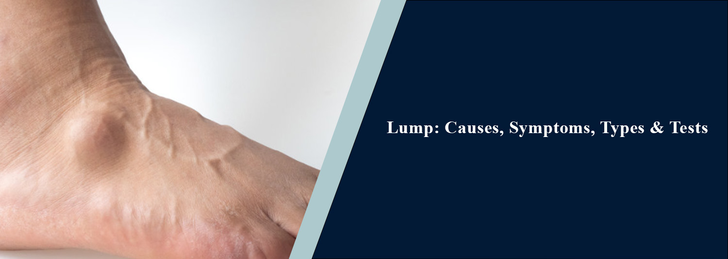Lump: Causes, Symptoms, Types & Tests