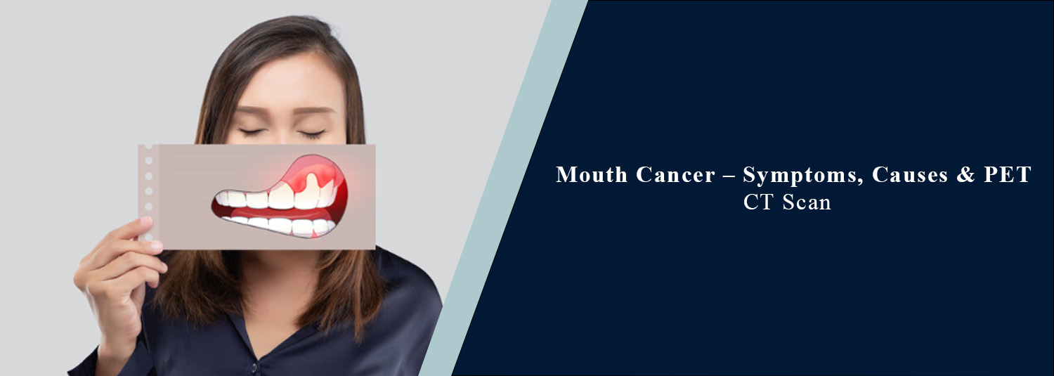 Mouth Cancer – Symptoms, Causes & PET CT Scan