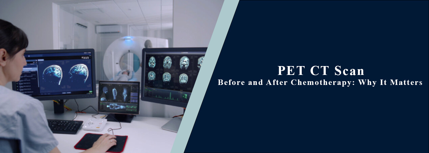 PET CT Scan Before and After Chemotherapy: Why It Matters?