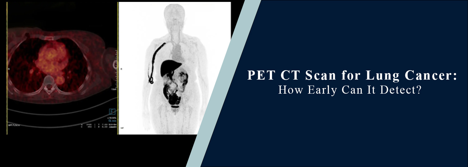 PET CT Scan for Lung Cancer: How Early Can It Detect?