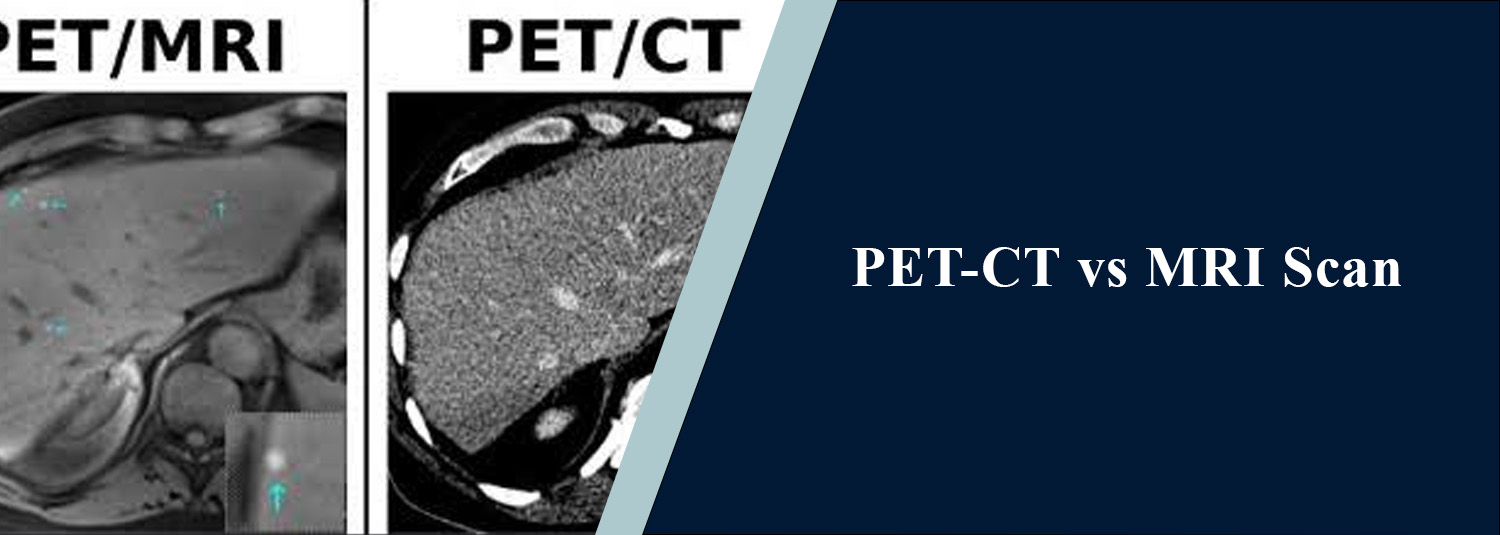 PET-CT vs MRI Scan: Differences, Uses, and Which Is Better for Cancer?