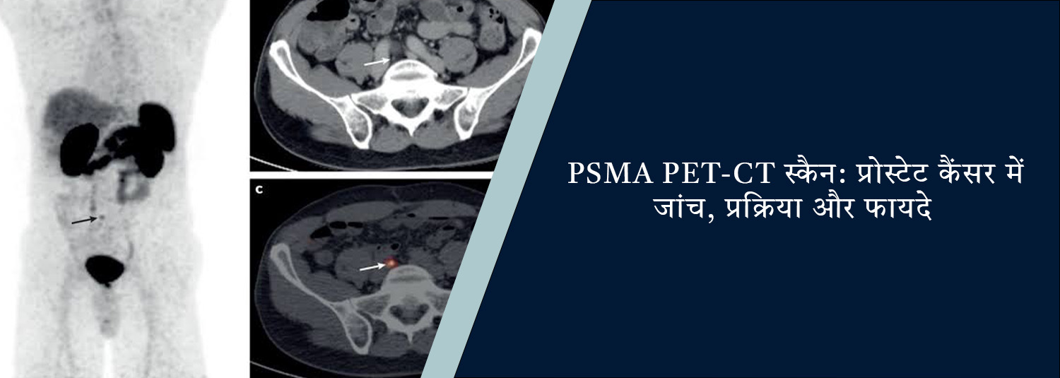 PSMA PET-CT स्कैन: प्रोस्टेट कैंसर में जांच, प्रक्रिया और फायदे