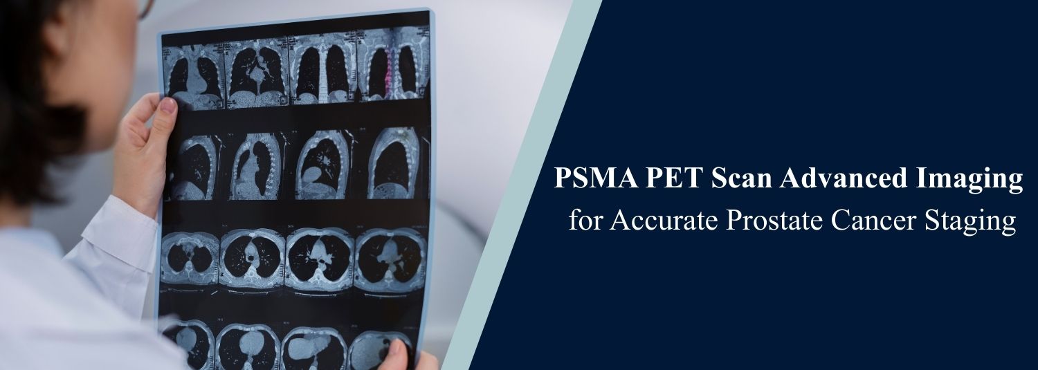 PSMA PET Scan Advanced Imaging for Accurate Prostate Cancer Staging