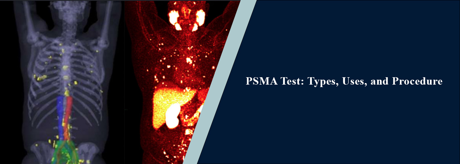PSMA Test: Types, Uses, and Procedure