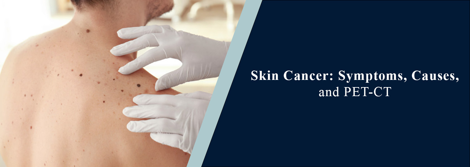Skin Cancer: Symptoms, Causes, Types and PET-CT