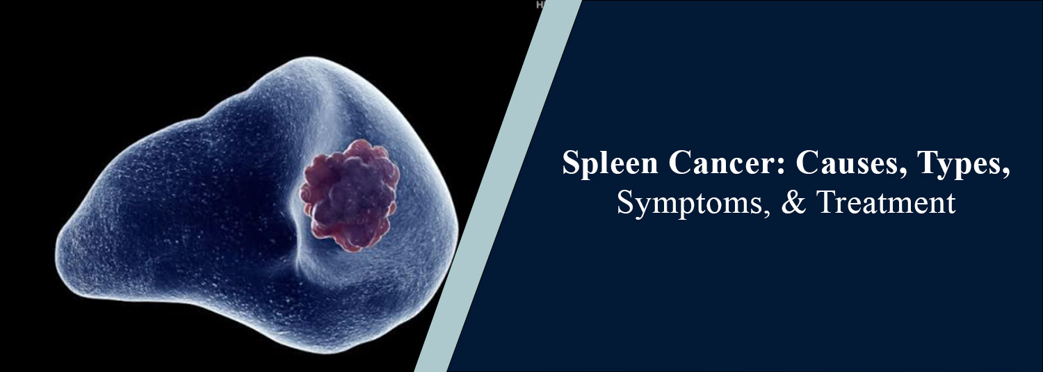 Spleen Cancer: Causes, Types, Symptoms, and Treatment