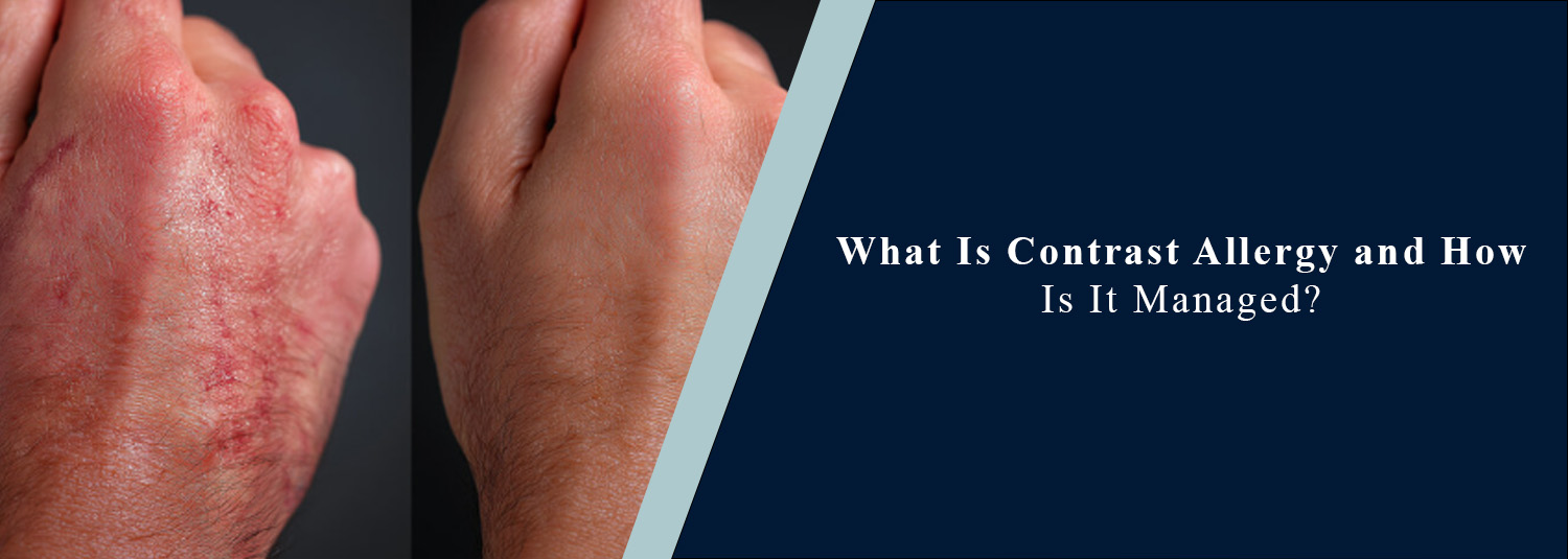What Is Contrast Allergy and How Is It Managed?