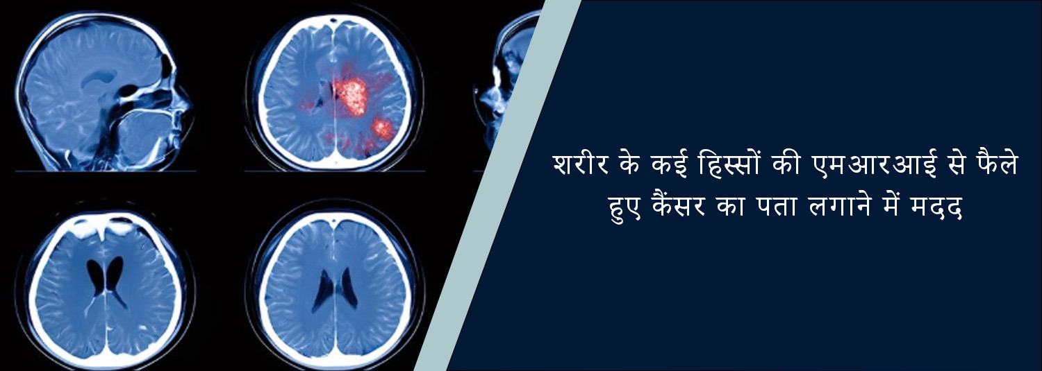 शरीर के कई हिस्सों की एमआरआई से फैले हुए कैंसर का पता लगाने में मदद