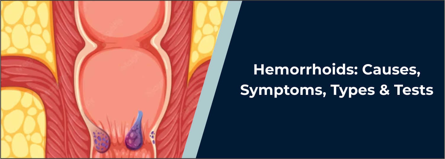 Hemorrhoids: Causes, Symptoms, Types & Tests