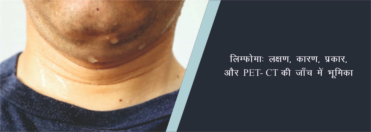 लिम्फोमा: लक्षण, कारण, प्रकार और PET-CT की जाँच में भूमिका