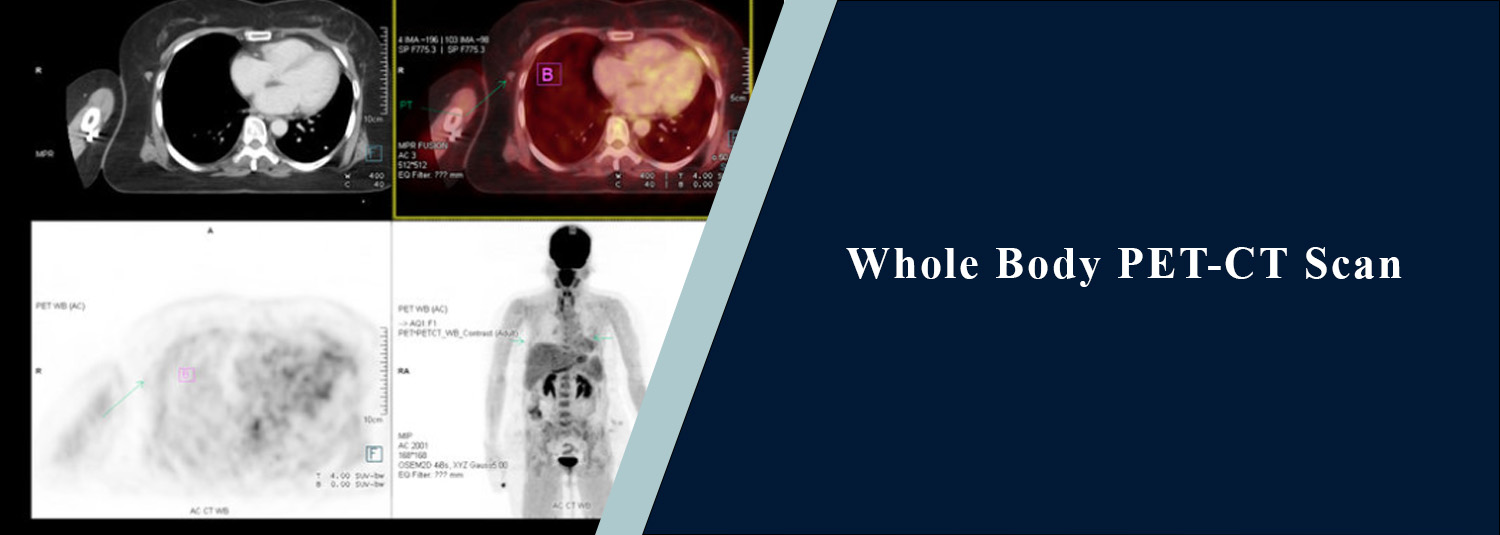 Whole Body PET-CT Scan