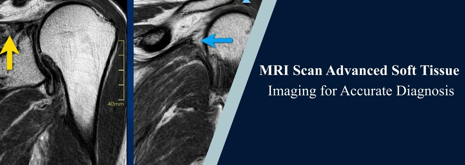 MRI Scan Advanced Soft Tissue Imaging for Accurate Diagnosis