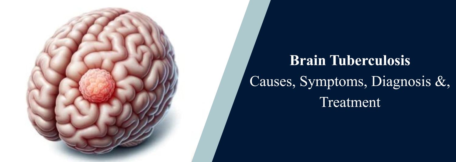 Brain Tuberculosis Causes, Symptoms, Diagnosis &, Treatment